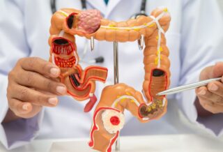 colon cancer screening