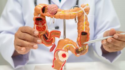 colon cancer screening