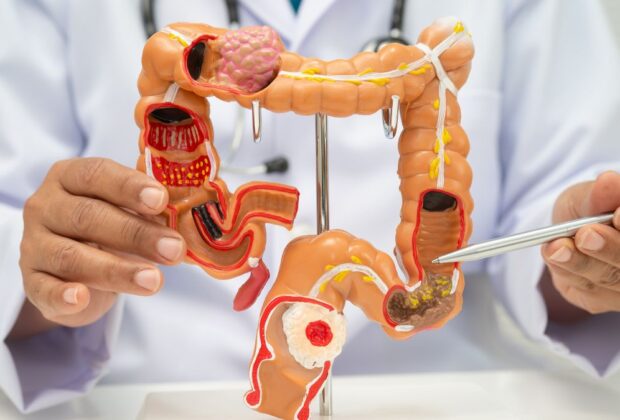 colon cancer screening