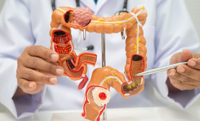 colon cancer screening